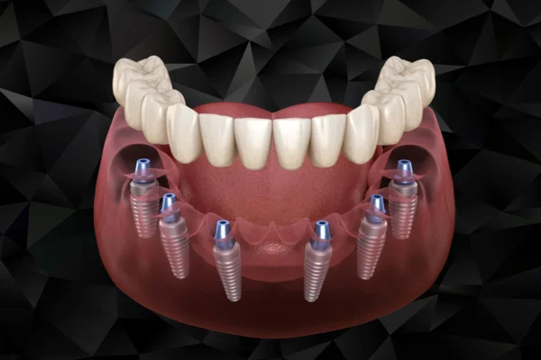 Full Arch Restoration: All-on-6 Implant in Turkey Benefits