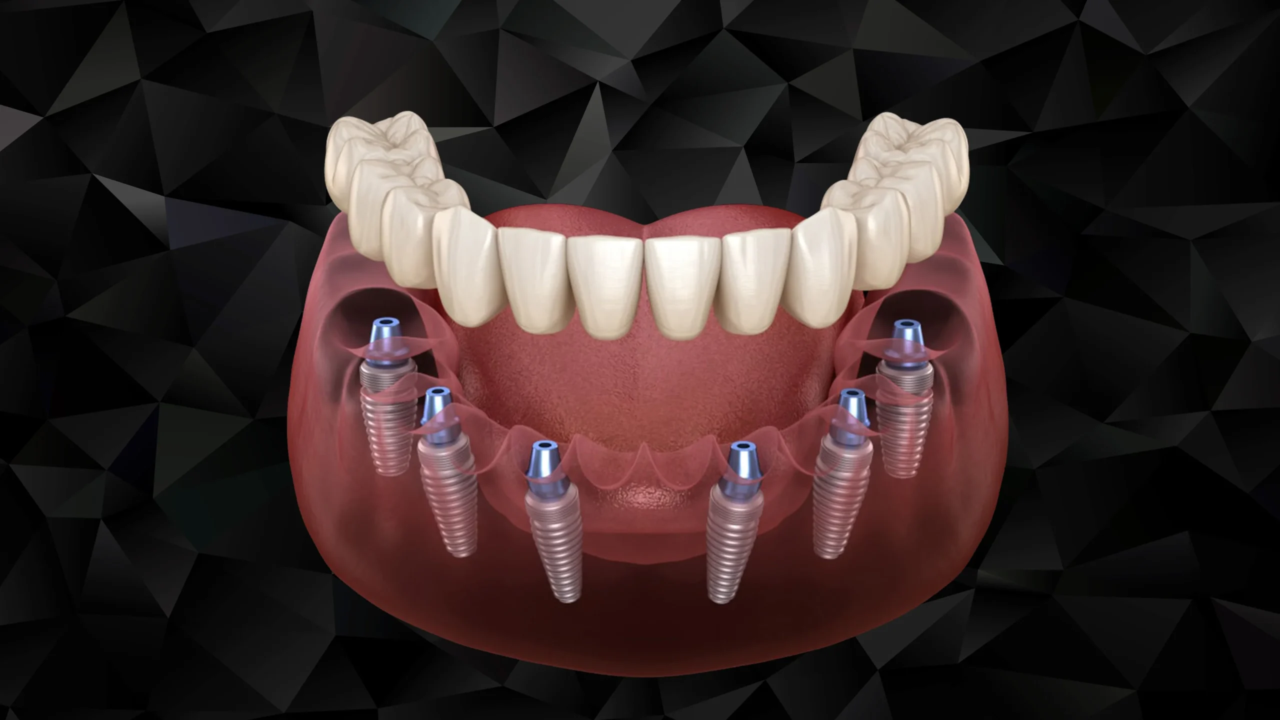 Full Arch Restoration: All-on-6 Implant in Turkey Benefits