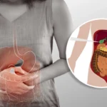 Gallbladder Issues: Navigating Post-Sleeve Complications