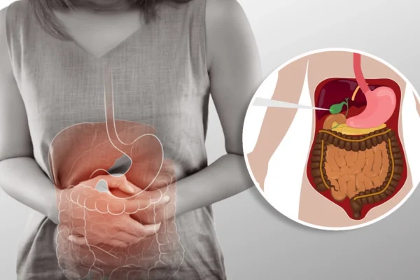 Gallbladder Issues: Navigating Post-Sleeve Complications