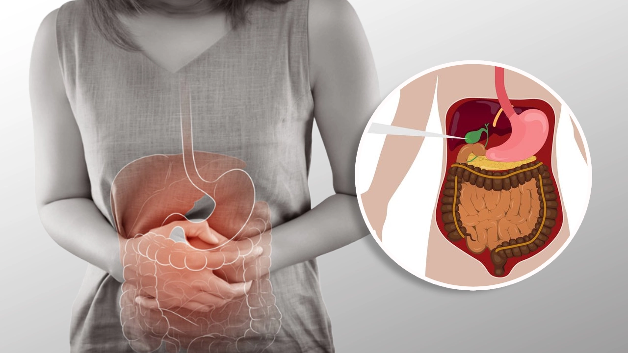 Gallbladder Issues: Navigating Post-Sleeve Complications