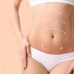 Post-Op Care: Navigating Extended Tummy Tuck Recovery