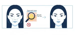 Cheek Contouring: Buccal Fat Reduction Explained