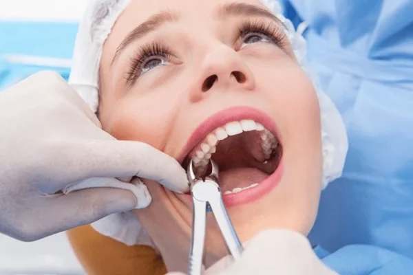 Wisdom Teeth Extraction: The Healing Journey