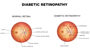 Diabetic Retinopathy: Advanced Treatment Options