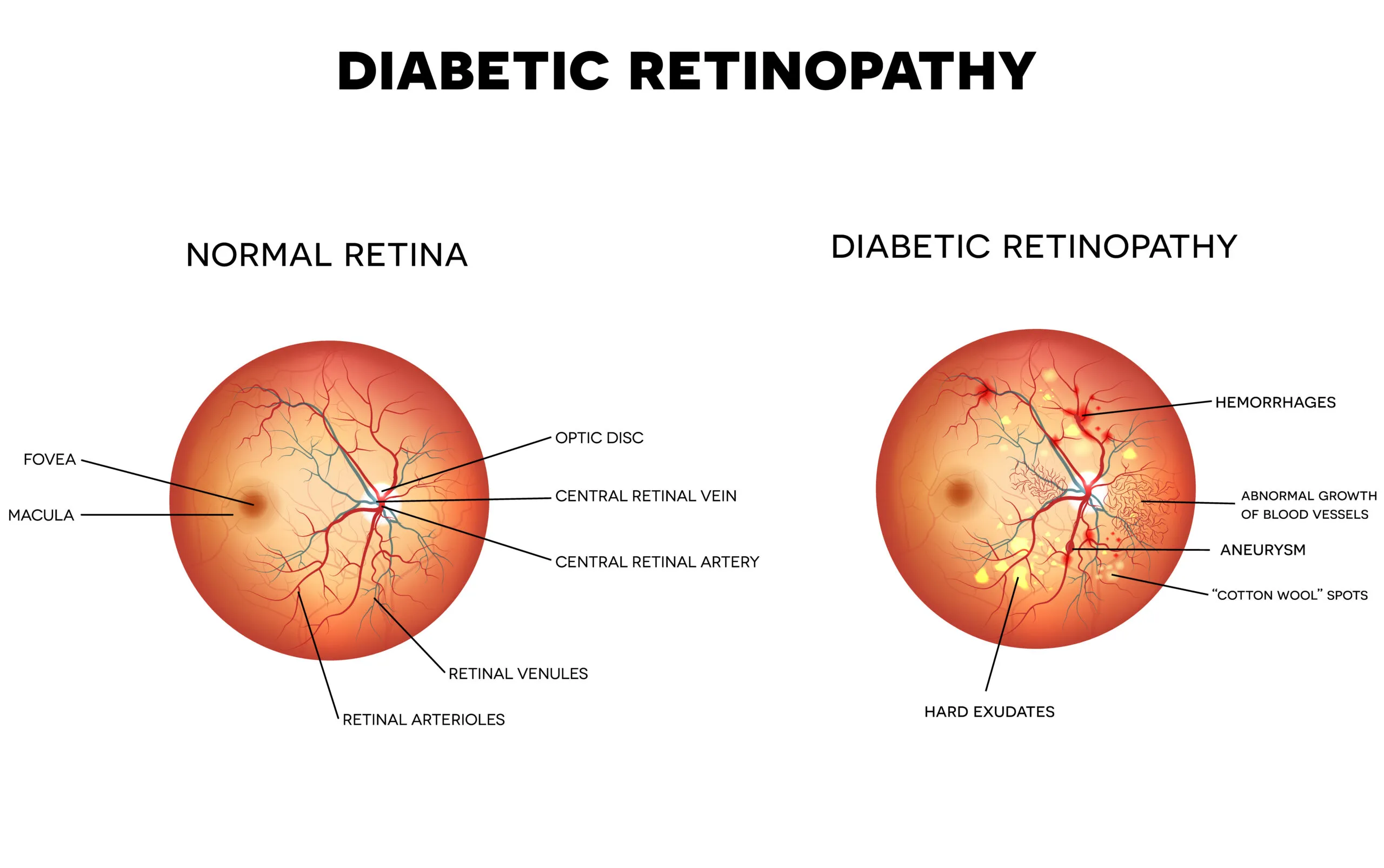 Diabetic Retinopathy: Advanced Treatment Options