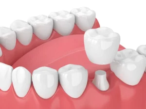 Crowns on Teeth: Restoring Your Smile's Strength