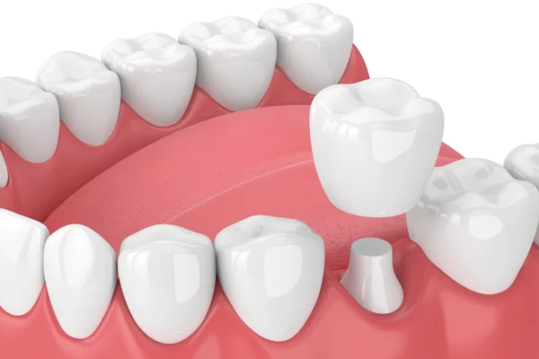 Crowns on Teeth: Restoring Your Smile's Strength