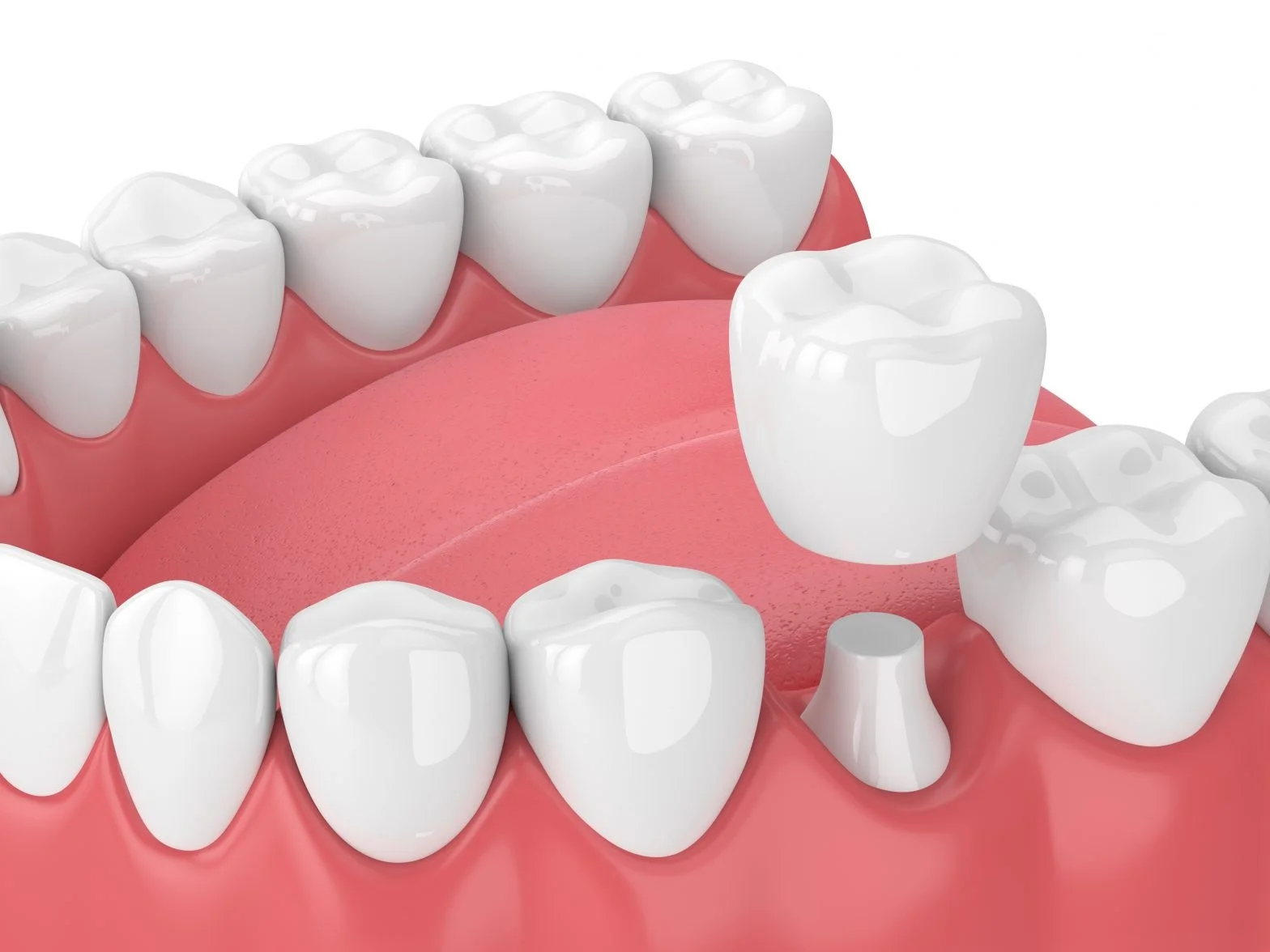 Crowns on Teeth: Restoring Your Smile's Strength