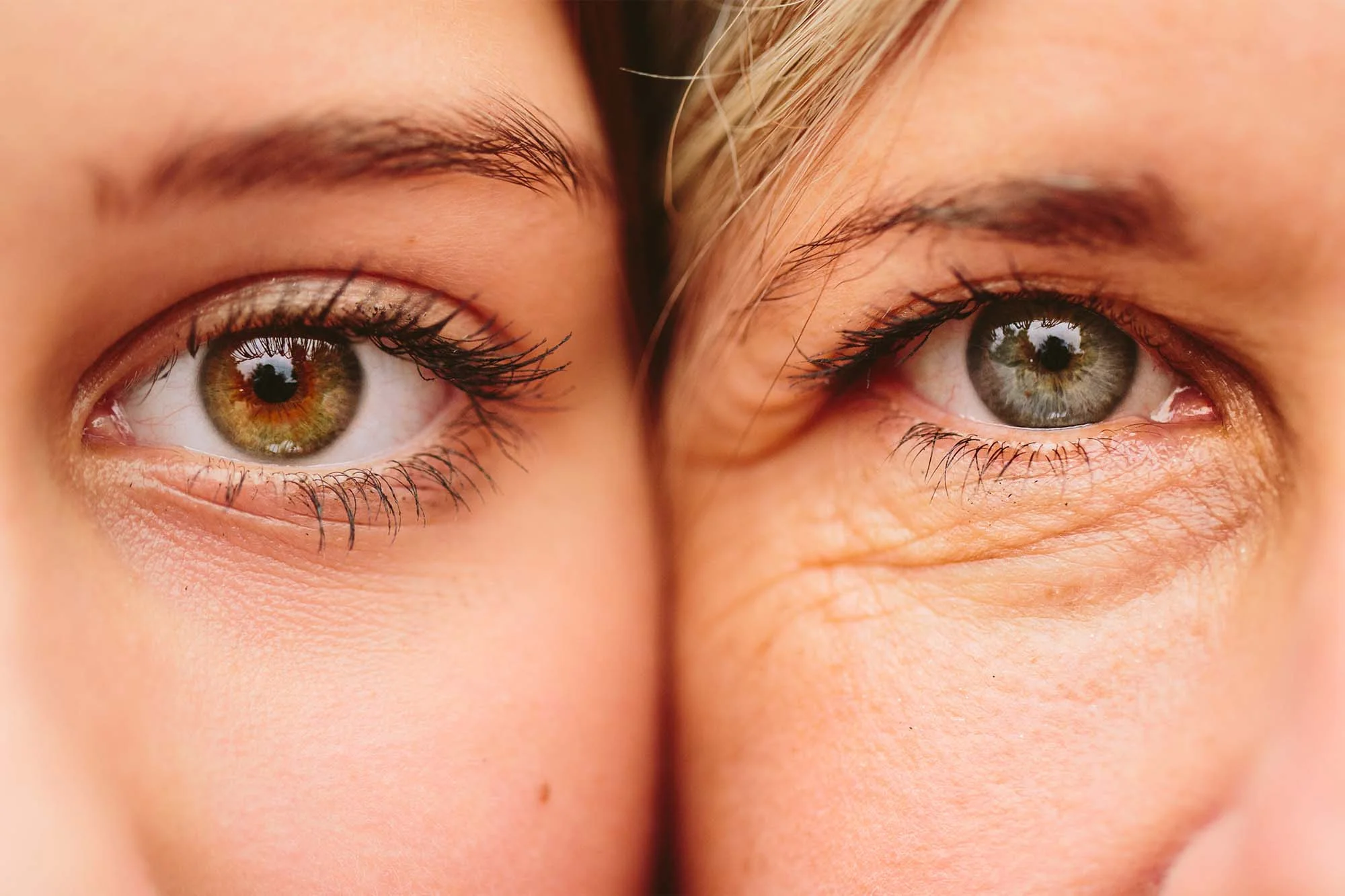Eye Rejuvenation for Hollow Eyes: Blepharoplasty & Fat Transfer