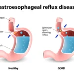 Reflux Resolution: Bariatric Surgery for GERD