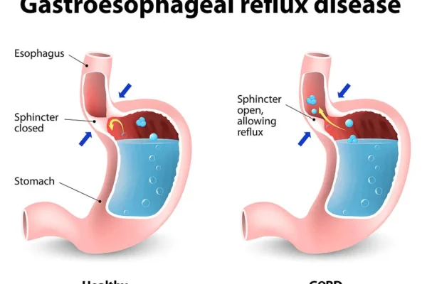 Reflux Resolution: Bariatric Surgery for GERD