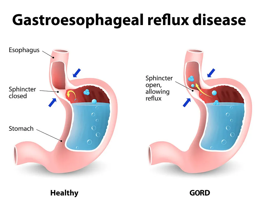 Reflux Resolution: Bariatric Surgery for GERD