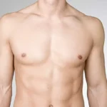 Male Chest Contouring: VASER Liposuction for Gynecomastia