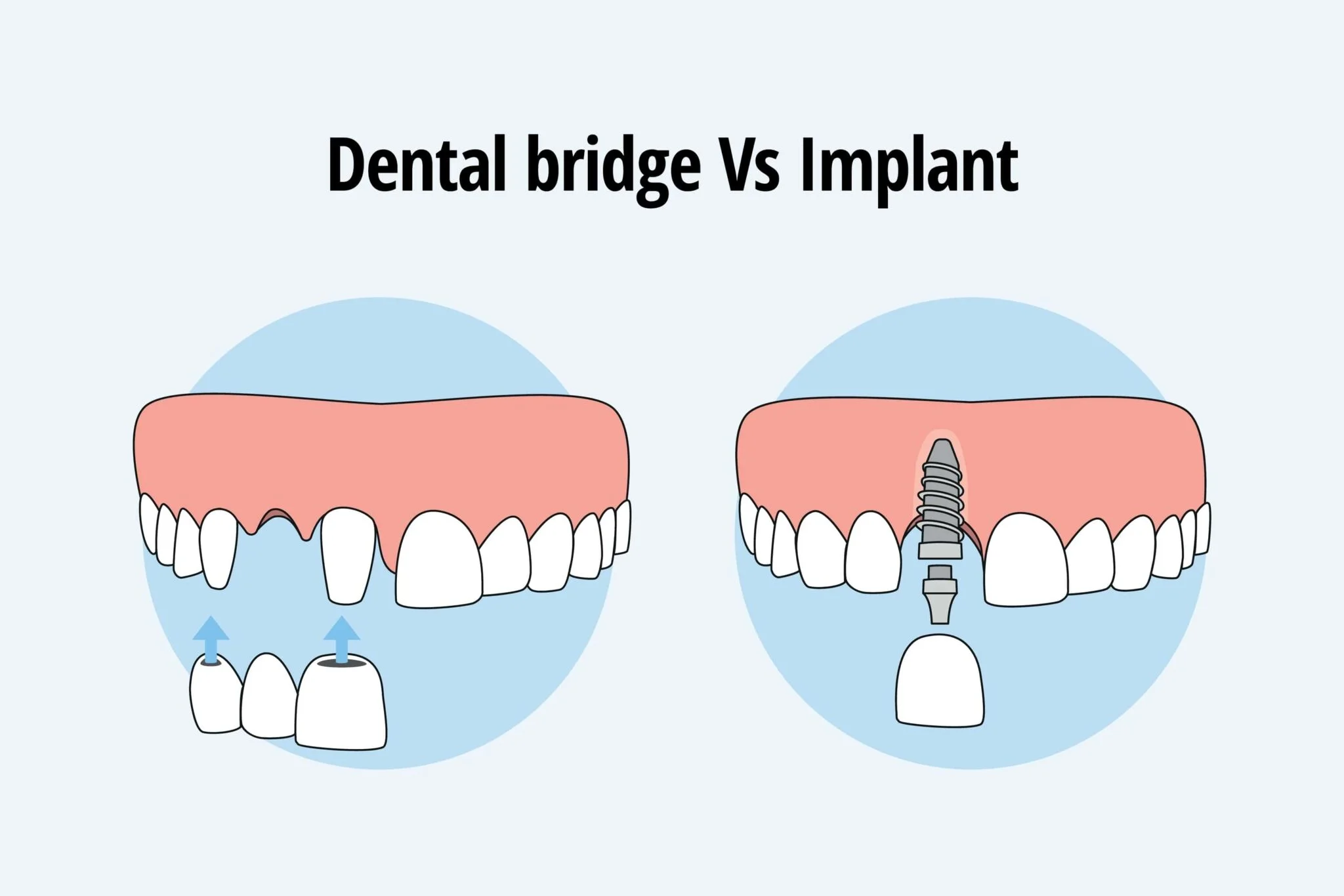 Missing Front Tooth: Implant or Bridge Choice