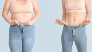 PCOS & Weight Loss: Surgical Solutions