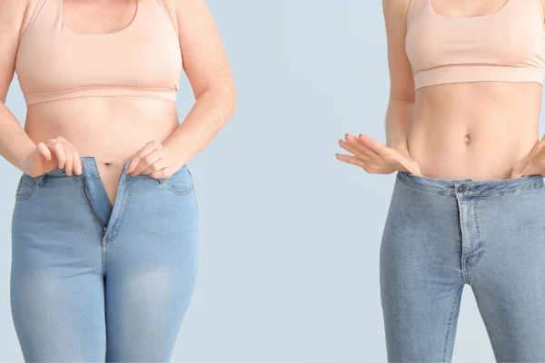 PCOS & Weight Loss: Surgical Solutions