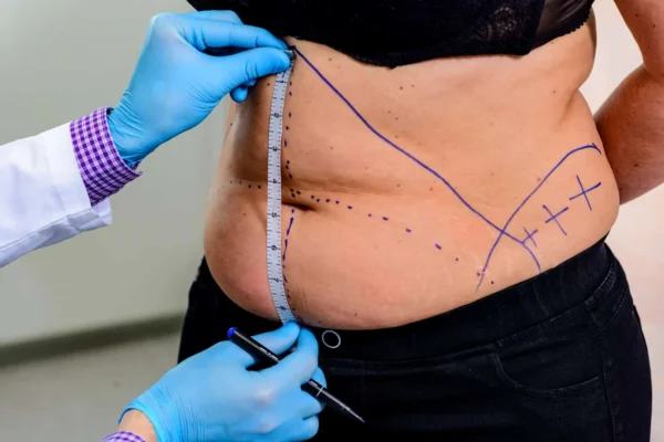 Body Contouring: Understanding Tummy Tuck Costs in Turkey