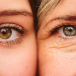 Eye Rejuvenation for Hollow Eyes: Blepharoplasty & Fat Transfer