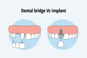 Missing Front Tooth: Implant or Bridge Choice
