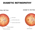 Diabetic Retinopathy: Advanced Treatment Options