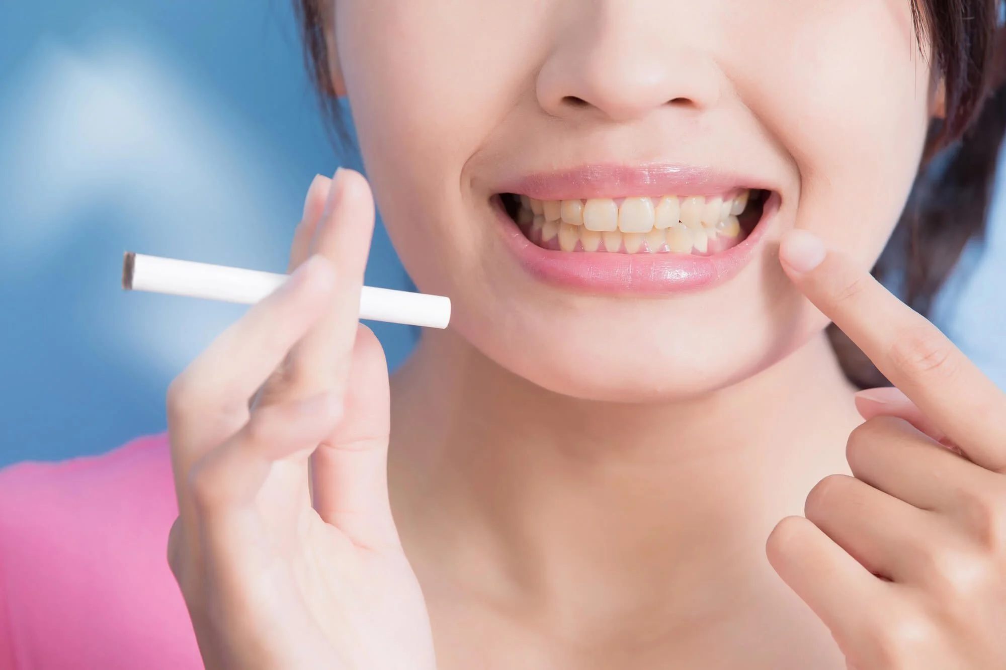 Dental Whitening: Addressing Smoker Discoloration