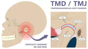 Jaw Pain Relief: Expert TMJ Disorder Treatment