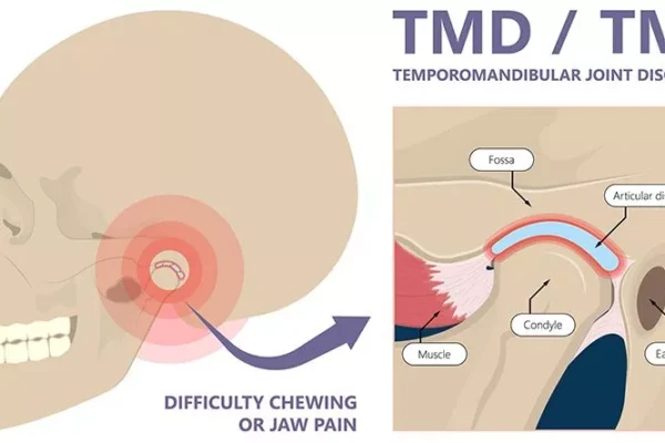 Jaw Pain Relief: Expert TMJ Disorder Treatment