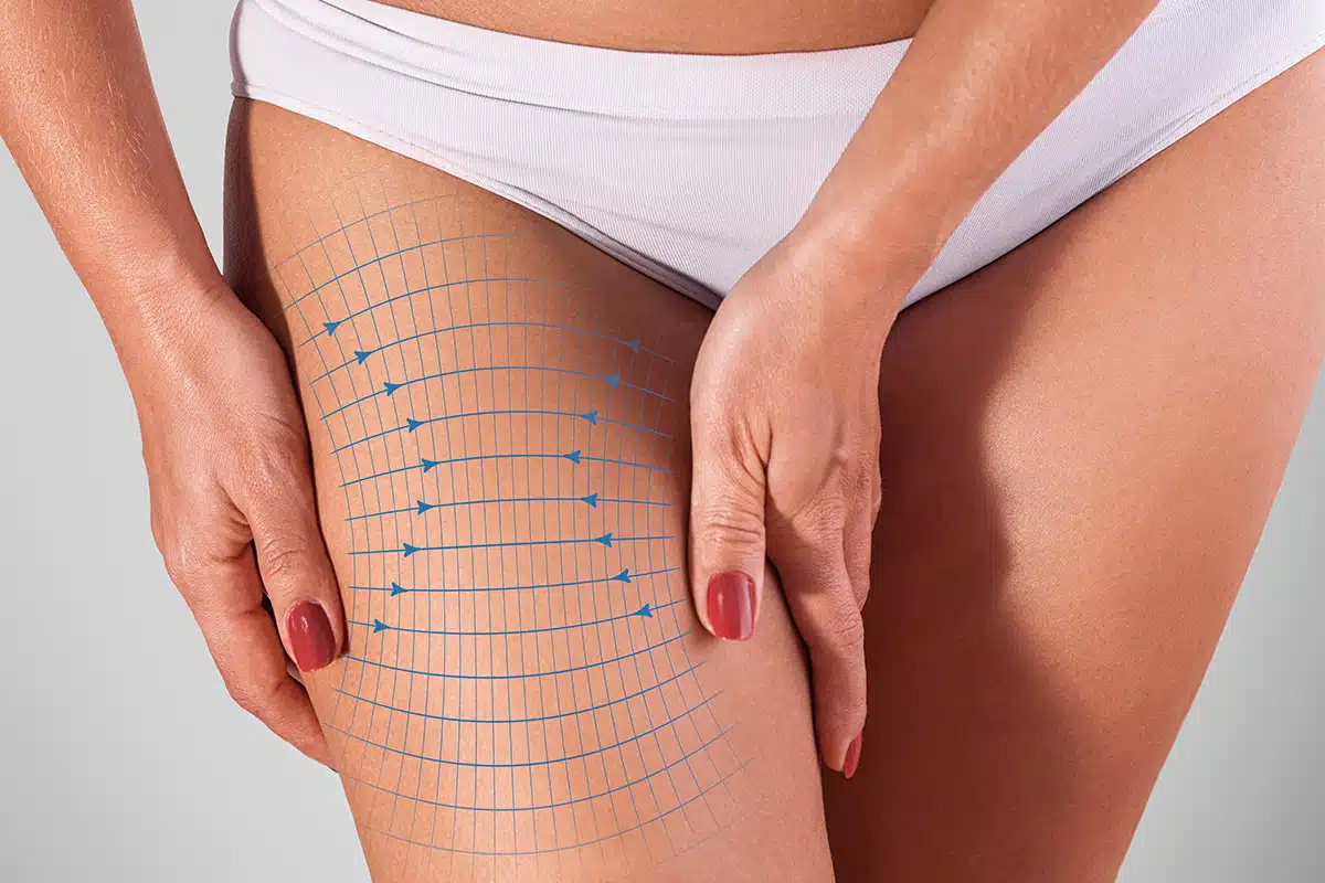 Understanding Thigh Lifts: Medial vs. Lateral