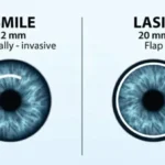 SMILE vs LASIK: Vision Correction Explained