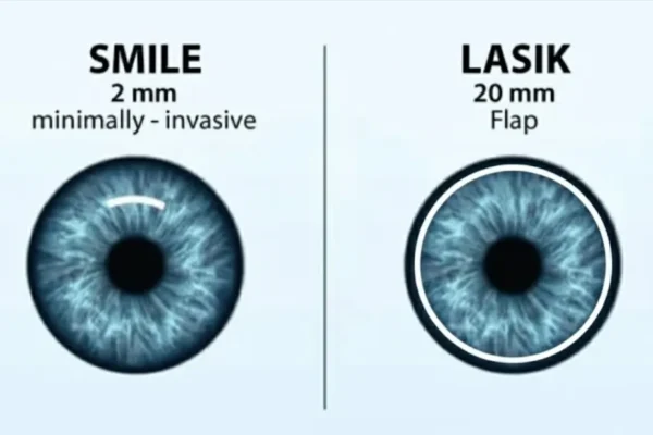 SMILE vs LASIK: Vision Correction Explained