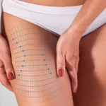 Understanding Thigh Lifts: Medial vs. Lateral
