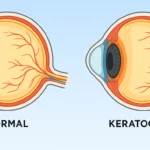 Keratoconus: Premium Contact Lens Solutions