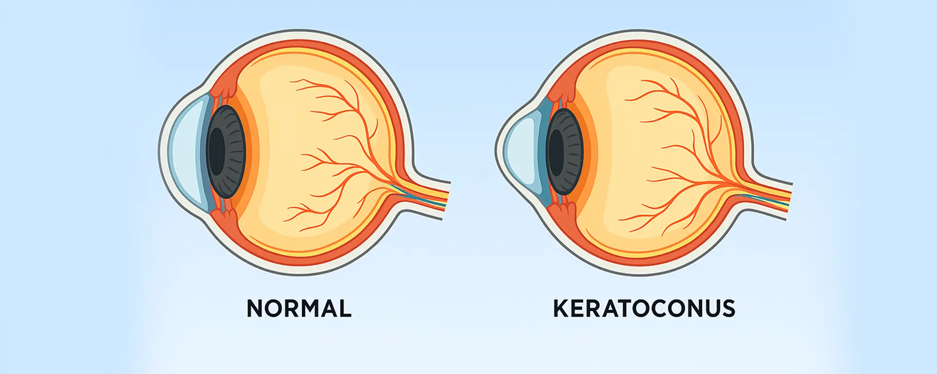 Keratoconus: Premium Contact Lens Solutions