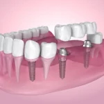 Dental Bridge Alternatives: Best Options Explained