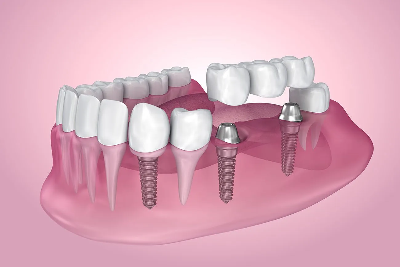 Dental Bridge Alternatives: Best Options Explained