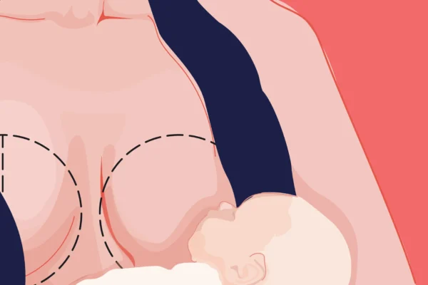 Mummy Makeover Timing: Breastfeeding & Weight Loss