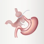 Bariatric Revision Cost and Process: Expert Insights