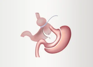 Bariatric Revision Cost and Process: Expert Insights