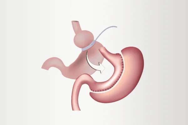 Bariatric Revision Cost and Process: Expert Insights