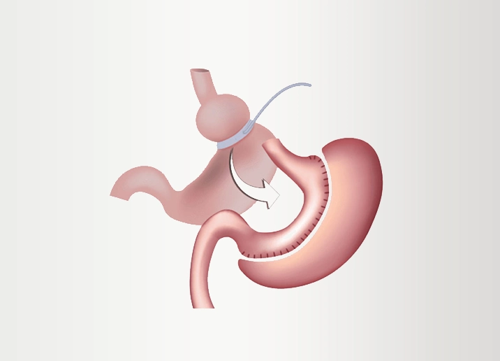 Bariatric Revision Cost and Process: Expert Insights