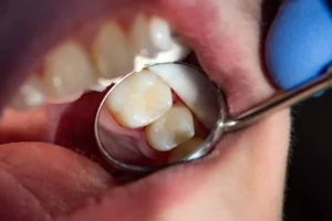 Crown Sensitivity: Relief When Your New Crown Hurts