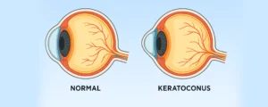 Keratoconus: Premium Contact Lens Solutions