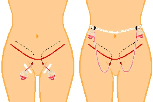 Understanding Drainage Tubes After Tummy Tuck