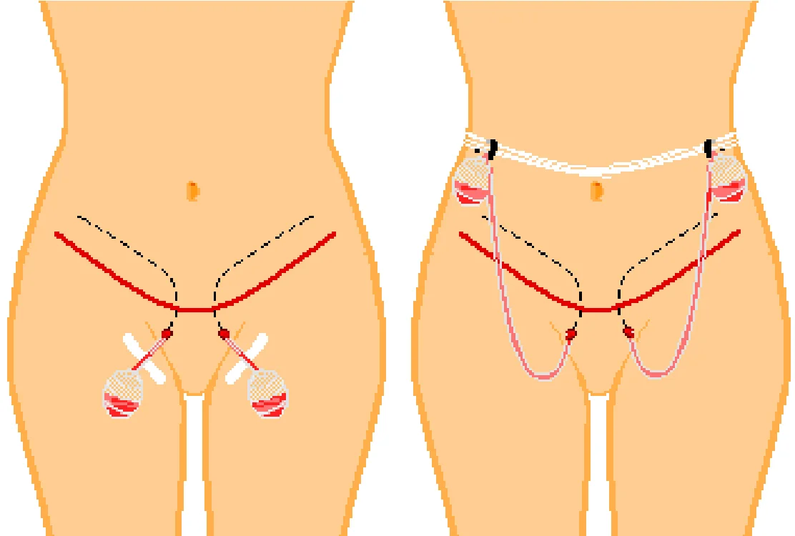 Understanding Drainage Tubes After Tummy Tuck
