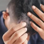 Patient Hair Loss: Prevention Strategies