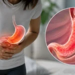 Gastric Sleeve with Gastritis: Can You Still Have Surgery?