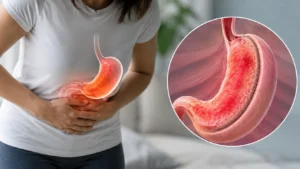 Gastric Sleeve with Gastritis: Can You Still Have Surgery?