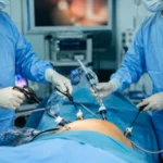 Bariatric Surgery with Umbilical Hernia Repair: Full Guide