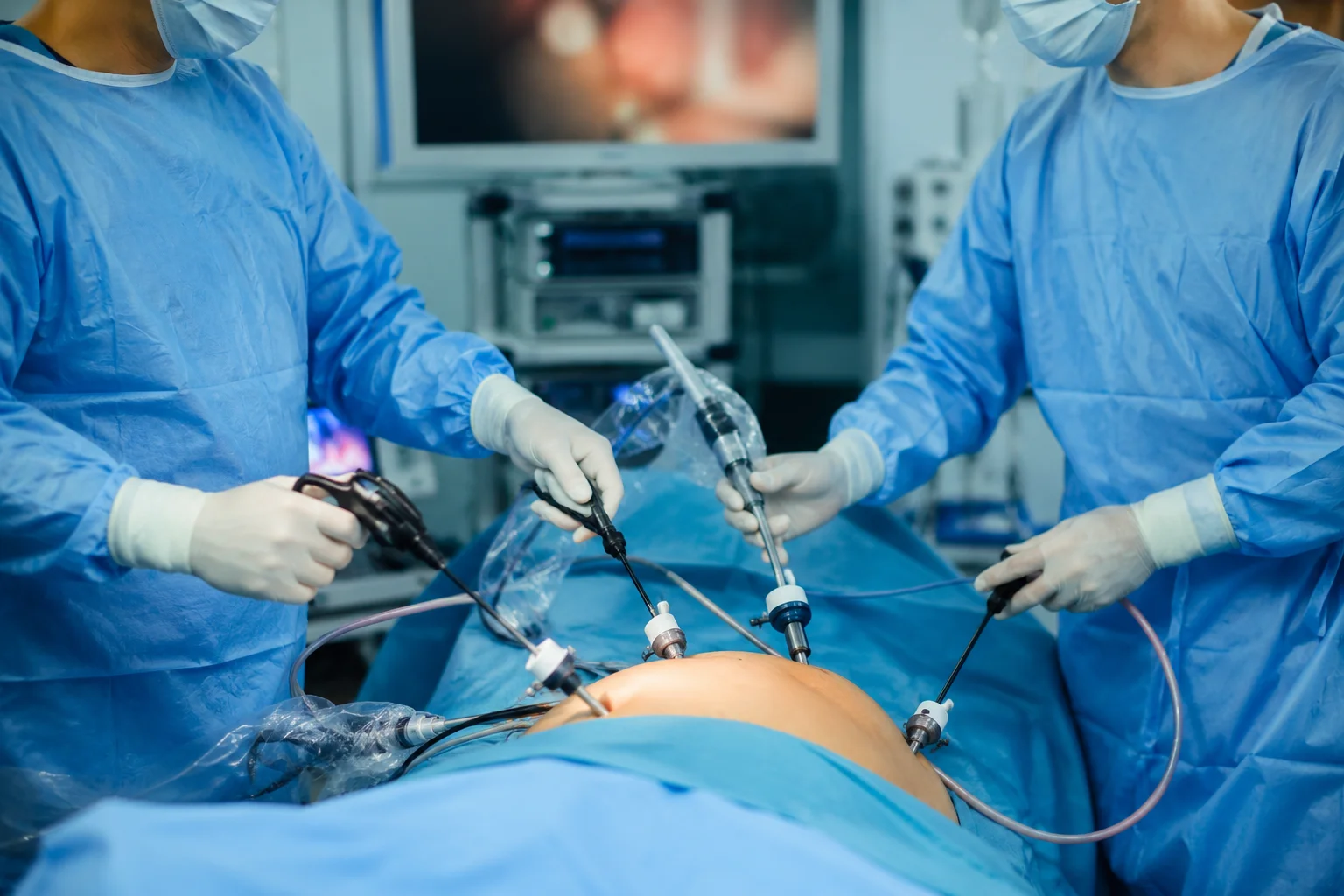 Bariatric Surgery with Umbilical Hernia Repair: Full Guide